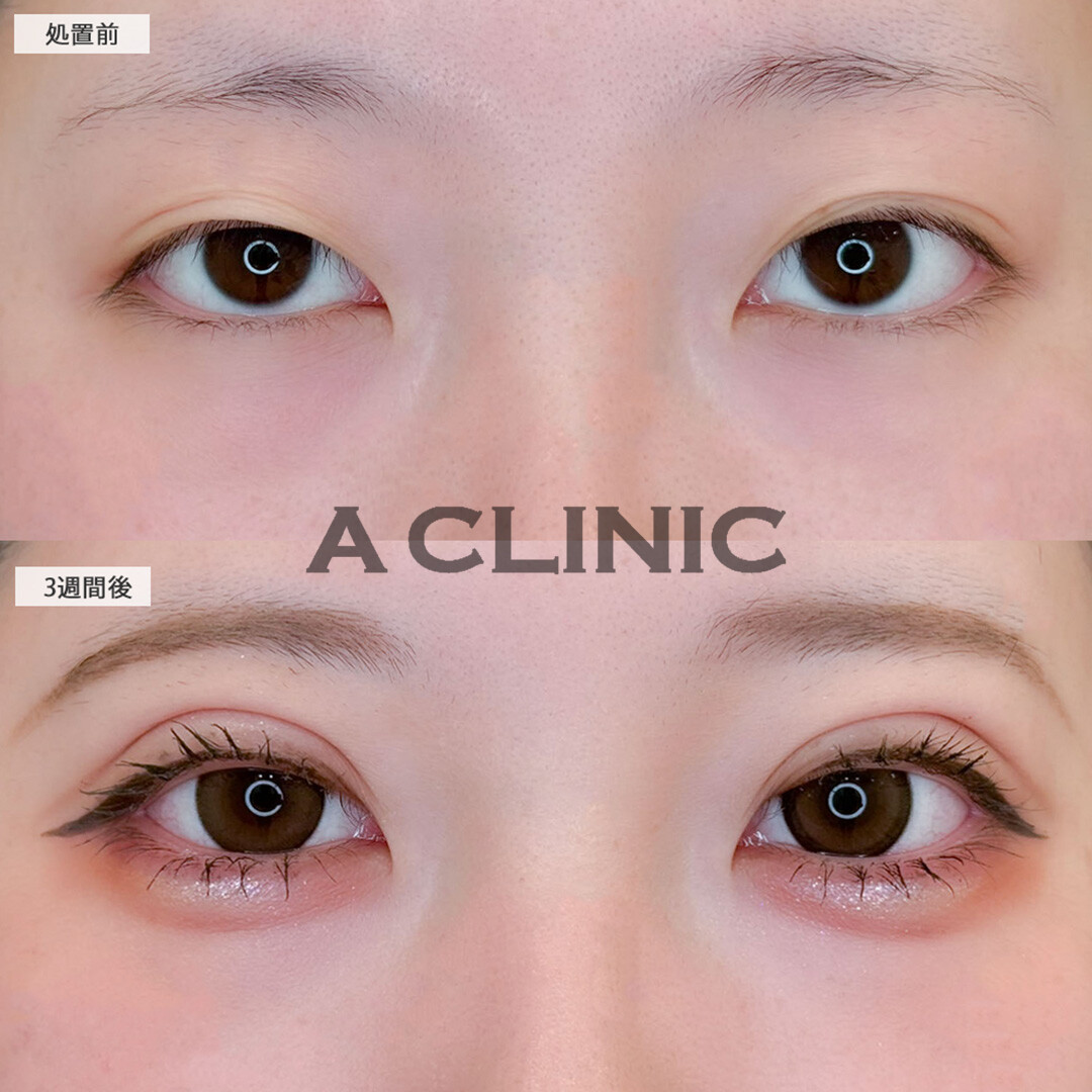 ドーリーアイズで目元が一気に垢抜けました！こちら処置前と3週間後の症例です(20代女性)