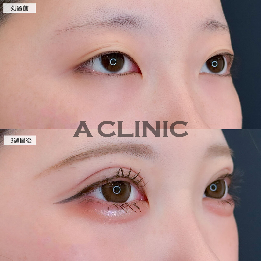ドーリーアイズで目元が一気に垢抜けました！こちら処置前と3週間後の症例です(20代女性)