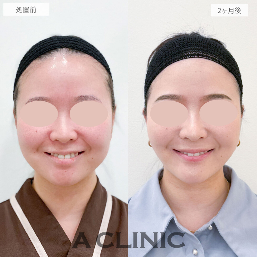 1day小顔脂肪吸引とバッカルファット除去術とナゾラビアルファット除去術と小顔エラボトックスとあごへのヒアルロン酸注入で骨切りいらずの理想の小顔を手に入れました！処置前と2ヶ月後の症例です(20代女性)
