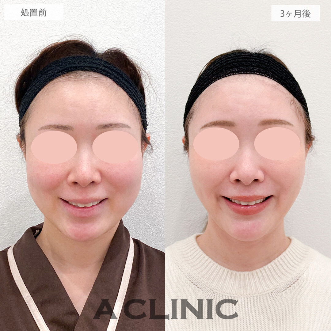 1day小顔脂肪吸引とバッカルファット除去術と小顔エラボトックスとあごへのヒアルロン酸注入でホホのたるみとボリュームがなくなりマイナス10歳若返りました！処置前と3ヶ月後の症例です(40代女性)