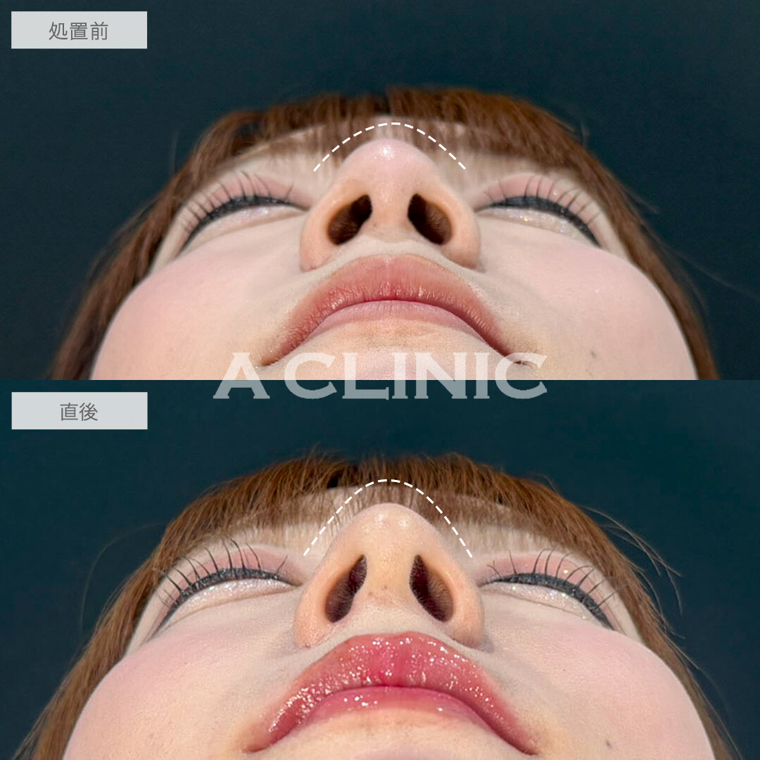 あごへのヒアルロン酸注入とコリアンノーズとリップへのヒアルロン酸でEラインが整い自然に垢抜け!こちら処置前と直後の症例です(20代女性)