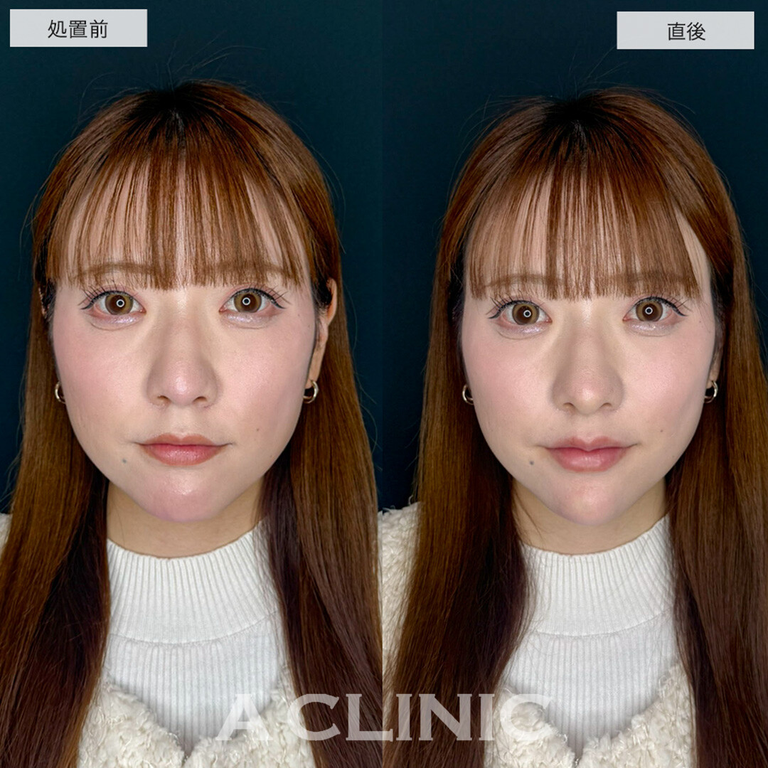 あごへのヒアルロン酸注入とコリアンノーズとリップへのヒアルロン酸でEラインが整い自然に垢抜け!こちら処置前と直後の症例です(20代女性)