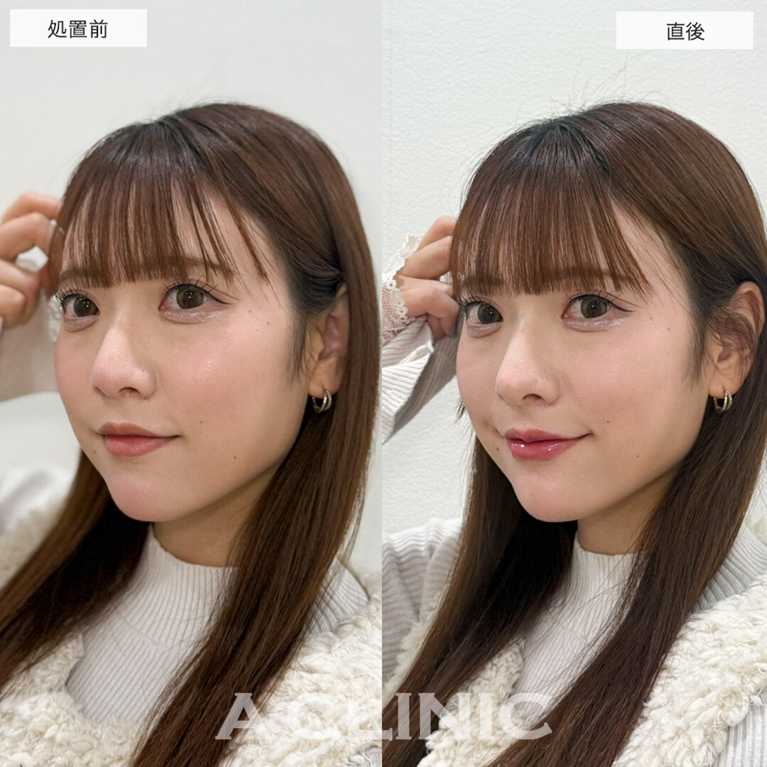 あごへのヒアルロン酸注入とコリアンノーズとリップへのヒアルロン酸でEラインが整い自然に垢抜け!こちら処置前と直後の症例です(20代女性)