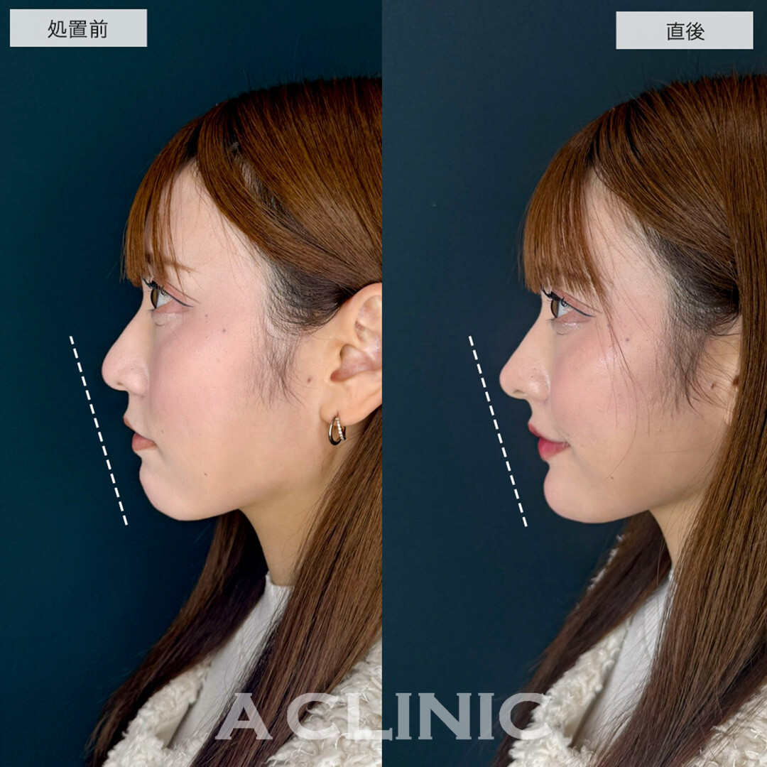 あごへのヒアルロン酸注入とコリアンノーズとリップへのヒアルロン酸でEラインが整い自然に垢抜け!こちら処置前と直後の症例です(20代女性)