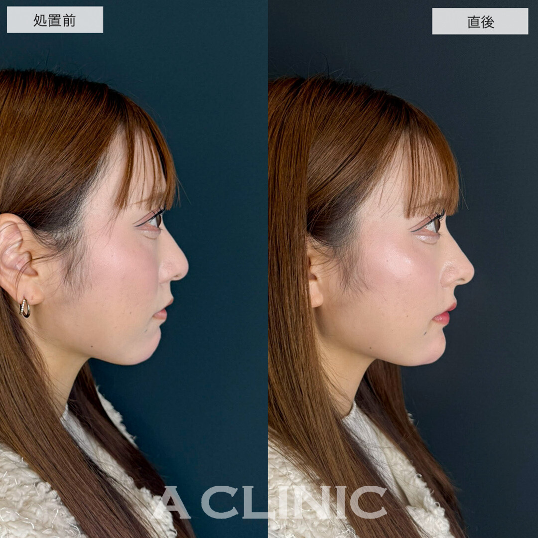 あごへのヒアルロン酸注入とコリアンノーズとリップへのヒアルロン酸でEラインが整い自然に垢抜け!こちら処置前と直後の症例です(20代女性)