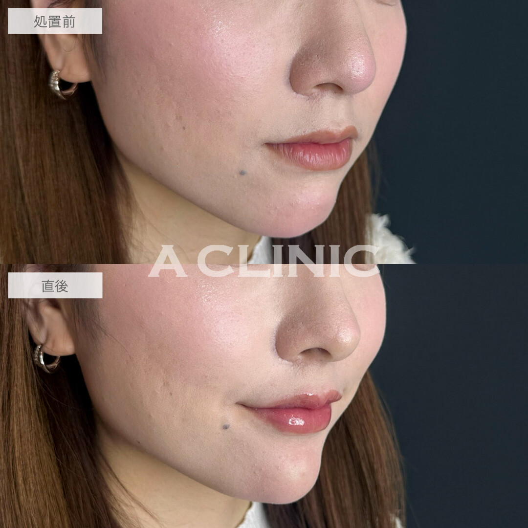 あごへのヒアルロン酸注入とコリアンノーズとリップへのヒアルロン酸でEラインが整い自然に垢抜け!こちら処置前と直後の症例です(20代女性)