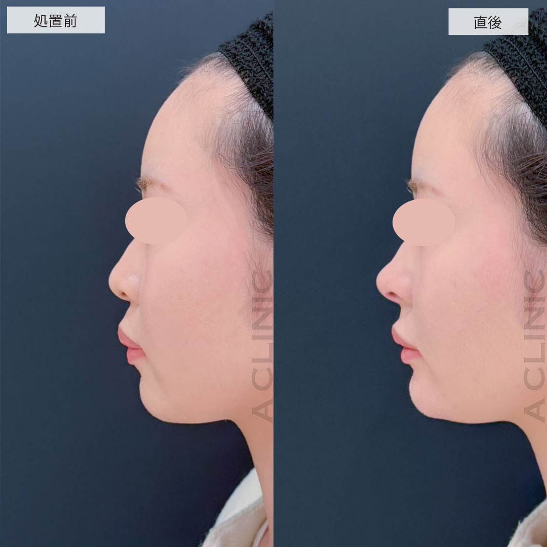 コリアンノーズとあごへのヒアルロン酸注入で直後から立体感のある横顔に！こちら処置前と直後の症例です(20代女性)