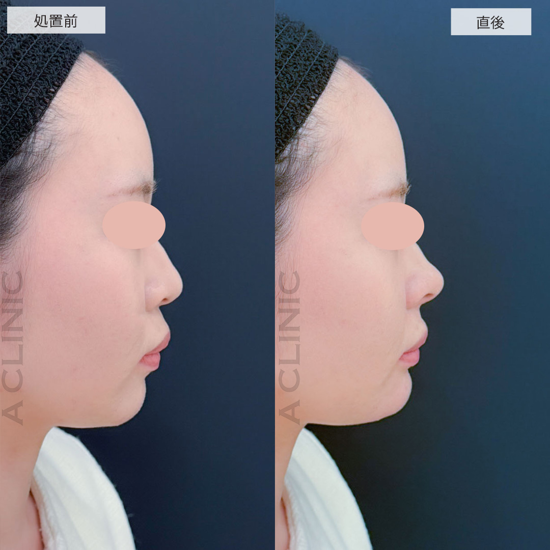 コリアンノーズとあごへのヒアルロン酸注入で直後から立体感のある横顔に！こちら処置前と直後の症例です(20代女性)