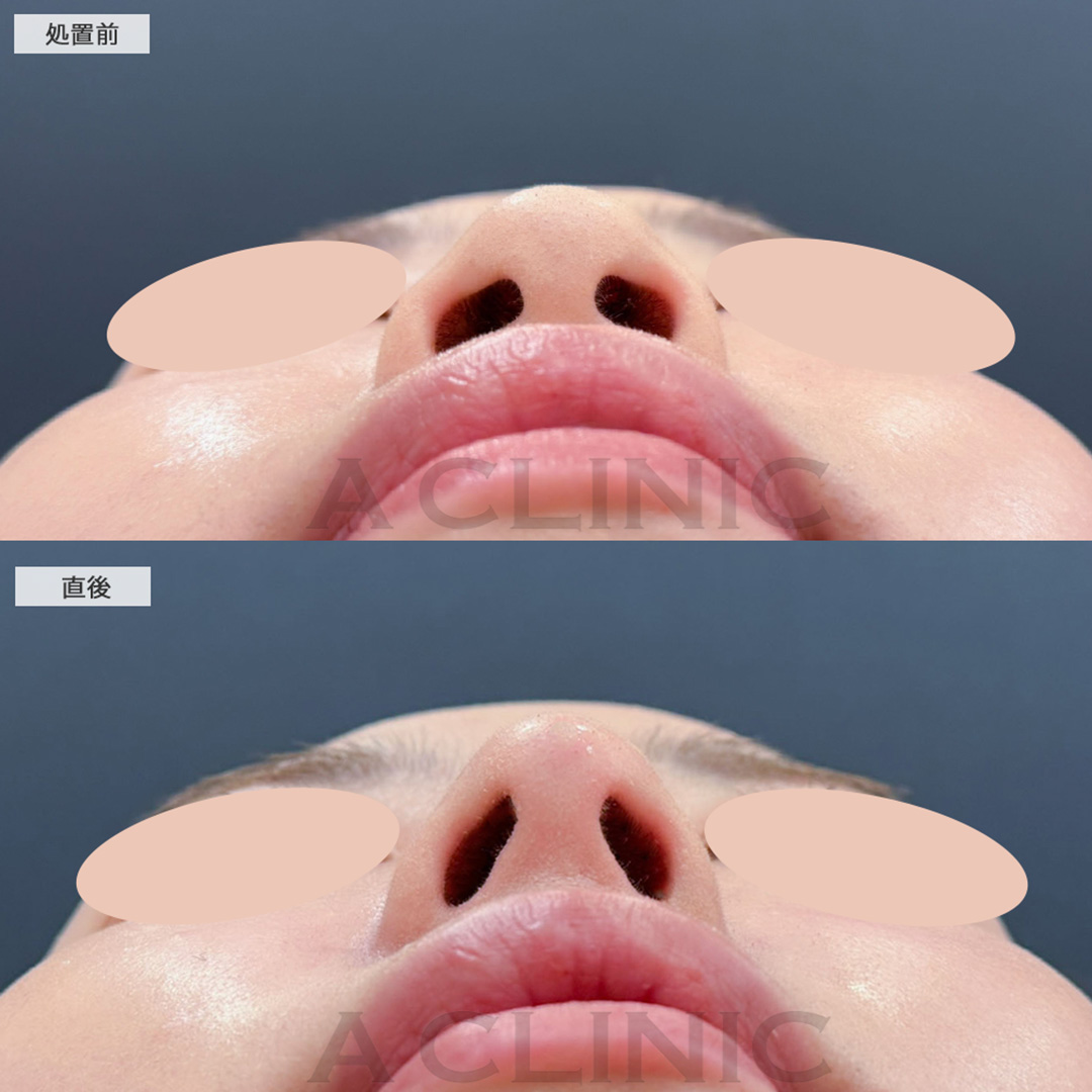 コリアンノーズとあごへのヒアルロン酸注入で直後から立体感のある横顔に！こちら処置前と直後の症例です(20代女性)