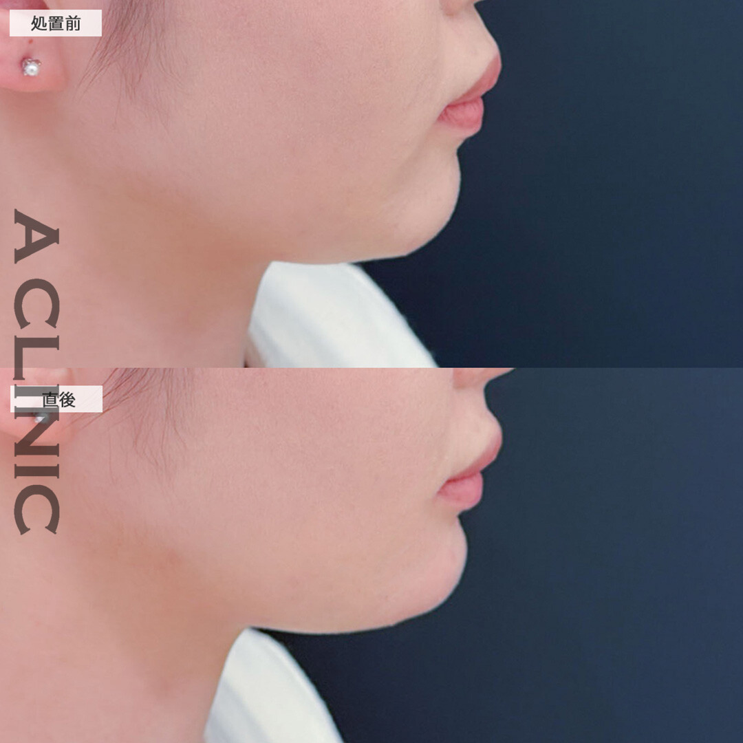 コリアンノーズとあごへのヒアルロン酸注入で直後から立体感のある横顔に！こちら処置前と直後の症例です(20代女性)