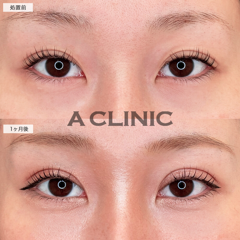 二重術埋没法で二重幅を広げてくっきり目元に！処置前から1ヶ月後の症例です(20代女性)