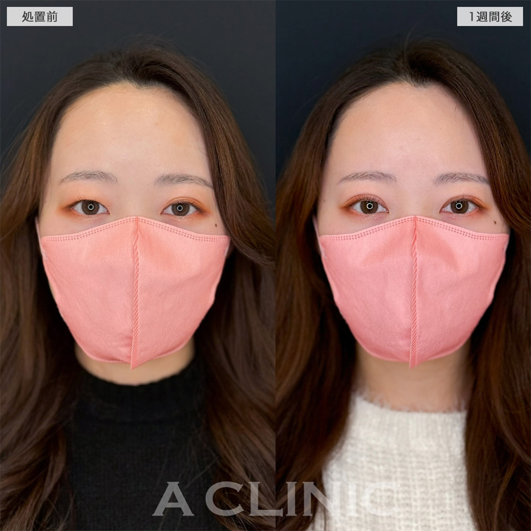 二重術埋没法で左右差解消し目元の印象をワンランク上へ!こちら処置前と1週間後の症例です(20代女性)