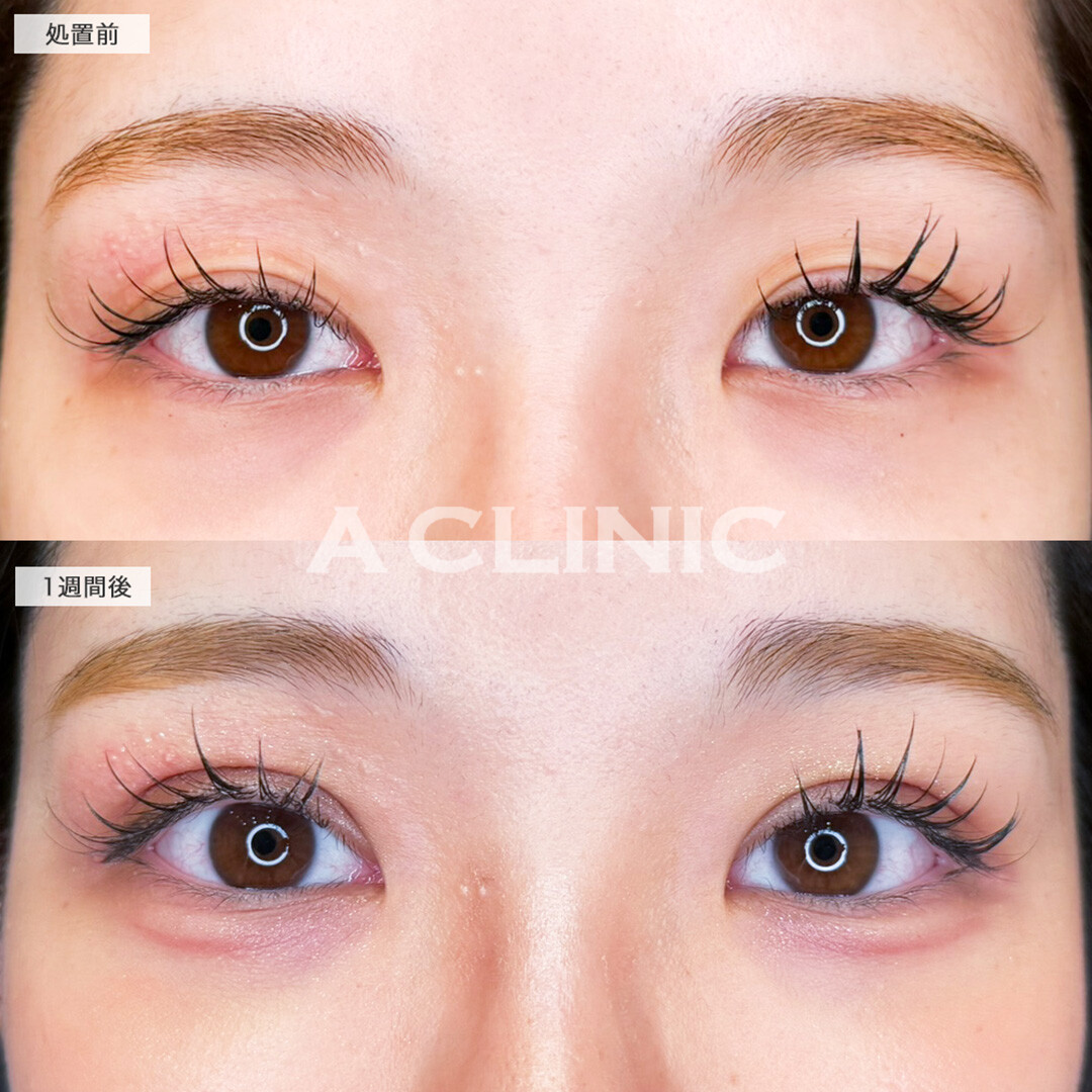 二重術埋没法でナチュラルなのに目元の存在感UP !こちら処置前と1週間後の症例です(20代女性)