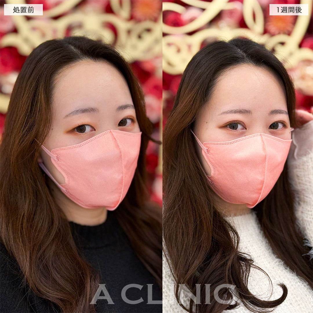 二重術埋没法で左右差解消し目元の印象をワンランク上へ!こちら処置前と1週間後の症例です(20代女性)