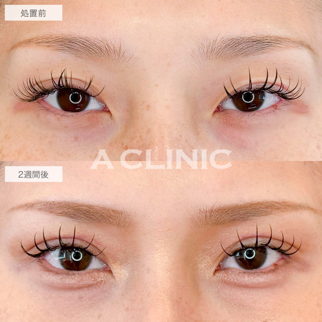 二重術埋没法とパーフェクトアイズで自然に目力アップ！処置前と2週間後の症例です(20代女性)