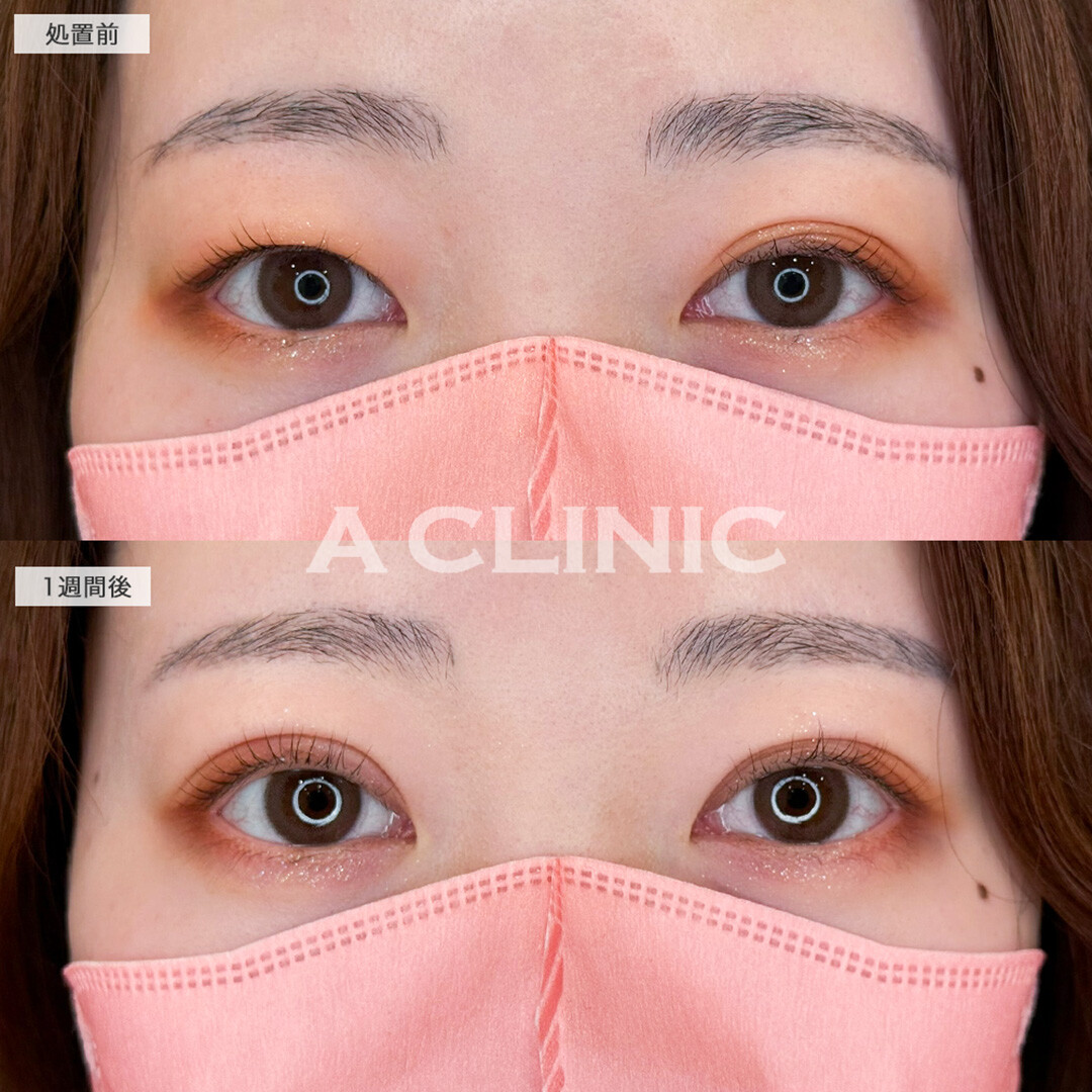 二重術埋没法で左右差解消し目元の印象をワンランク上へ!こちら処置前と1週間後の症例です(20代女性)