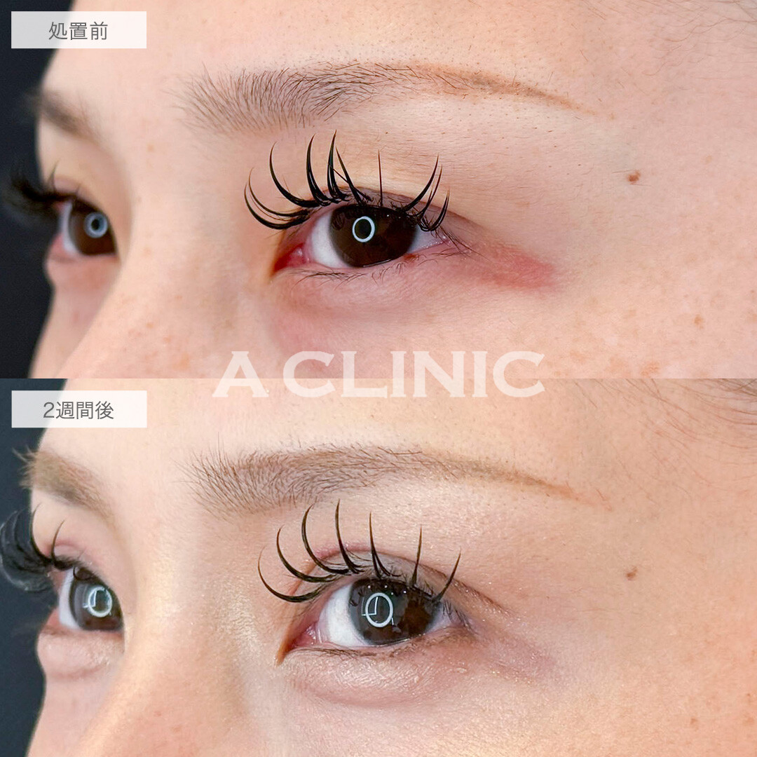 二重術埋没法とパーフェクトアイズで自然に目力アップ！処置前と2週間後の症例です(20代女性)