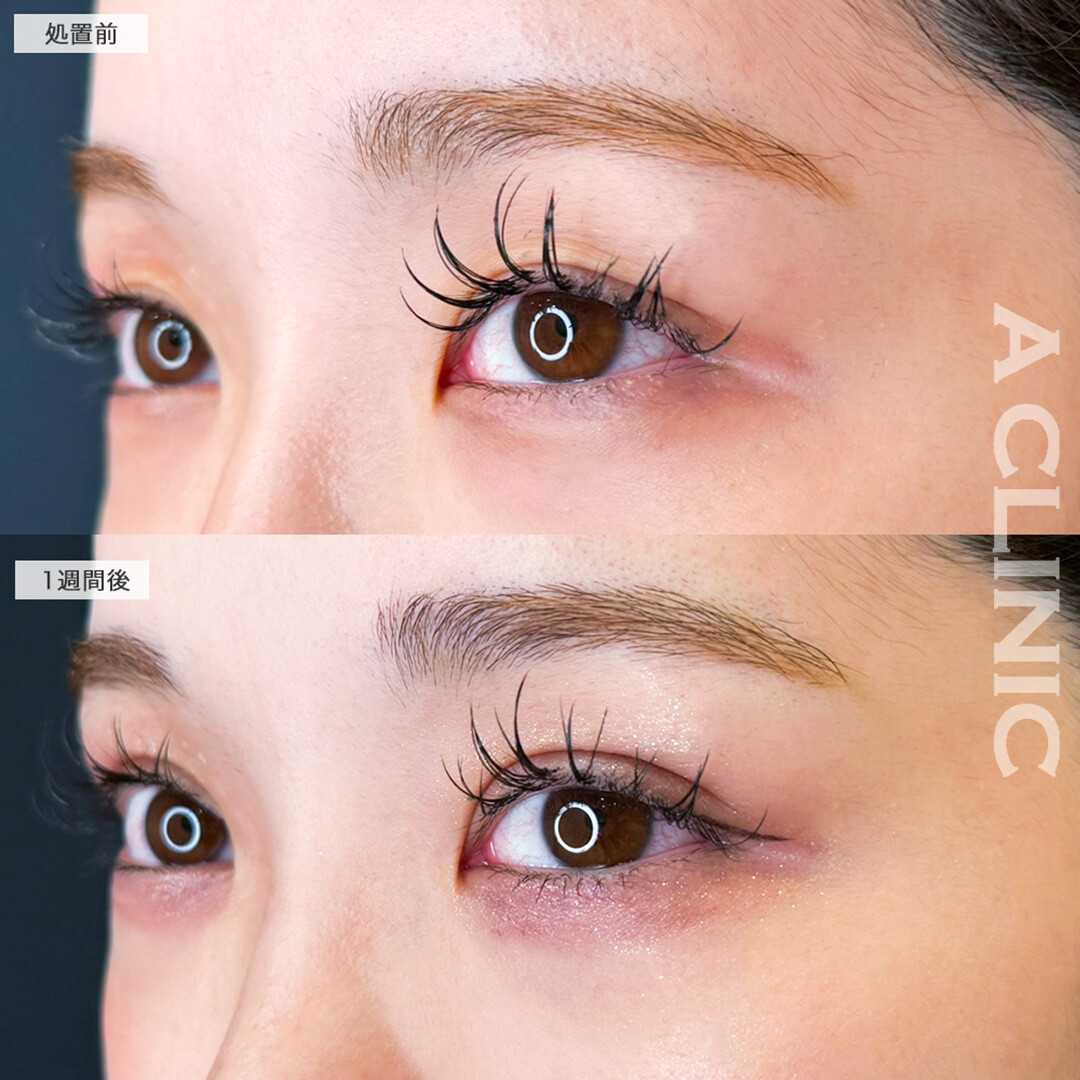 二重術埋没法でナチュラルなのに目元の存在感UP !こちら処置前と1週間後の症例です(20代女性)