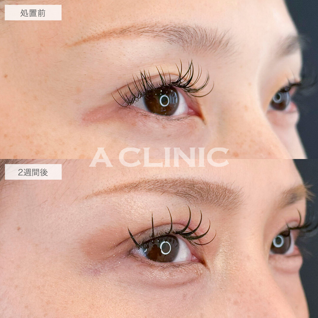 二重術埋没法とパーフェクトアイズで自然に目力アップ！処置前と2週間後の症例です(20代女性)
