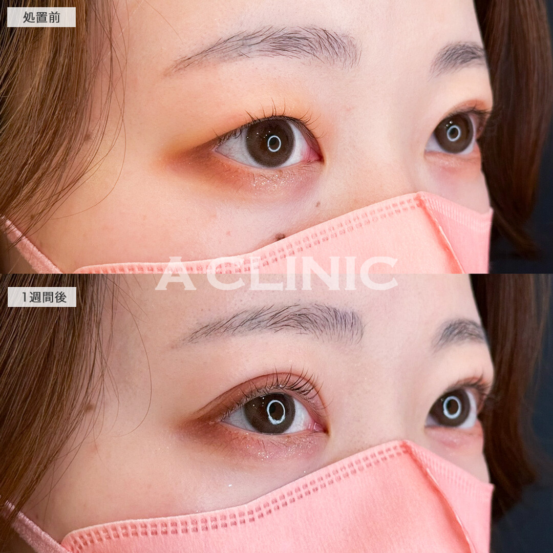 二重術埋没法で左右差解消し目元の印象をワンランク上へ!こちら処置前と1週間後の症例です(20代女性)