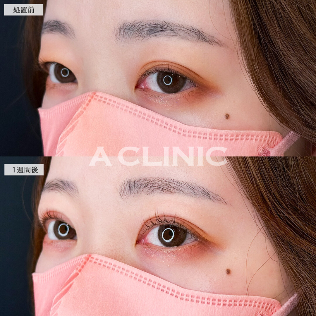 二重術埋没法で左右差解消し目元の印象をワンランク上へ!こちら処置前と1週間後の症例です(20代女性)