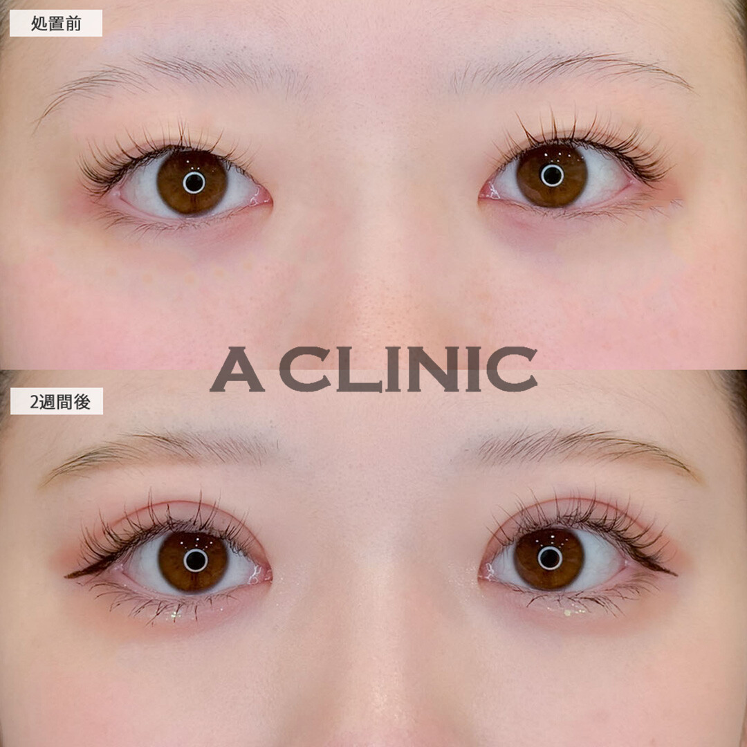 二重術埋没法でアイテープいらずのぱっちりキュートな二重に！こちら処置前と2週間後の症例です(20代女性)