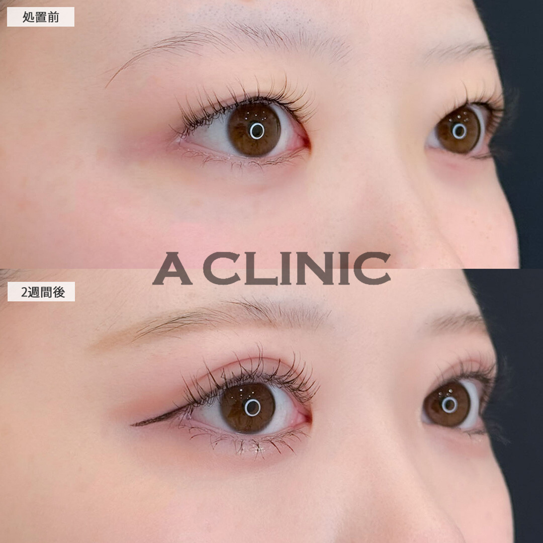 二重術埋没法でアイテープいらずのぱっちりキュートな二重に！こちら処置前と2週間後の症例です(20代女性)