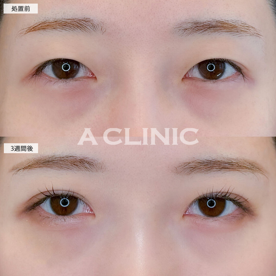 二重術埋没法で自然と幅を広げ理想の末広型の目元になりました！こちら処置前と3週間後の症例です(20代女性)