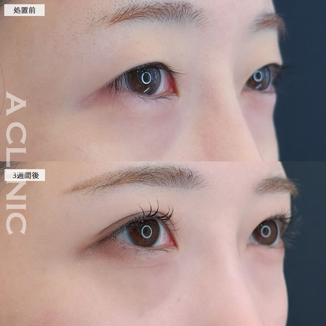二重術埋没法で自然と幅を広げ理想の末広型の目元になりました！こちら処置前と3週間後の症例です(20代女性)
