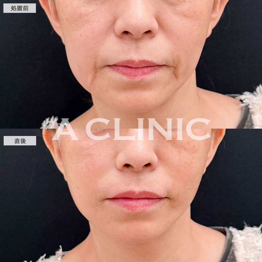 ヒアルロン酸注射(シワ)で長年のほうれい線が綺麗になくなりました！こちら処置前と直後の症例です(50歳女性)