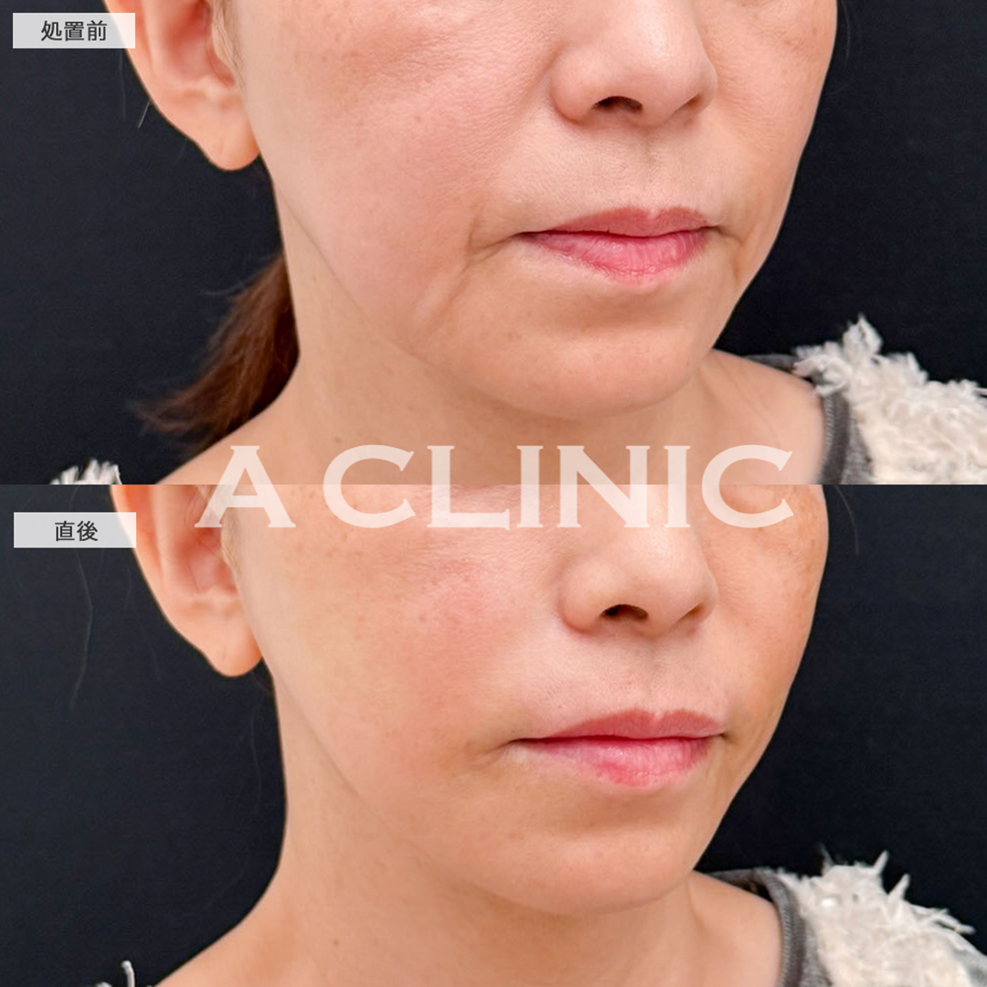 ヒアルロン酸注射(シワ)で長年のほうれい線が綺麗になくなりました！こちら処置前と直後の症例です(50歳女性)