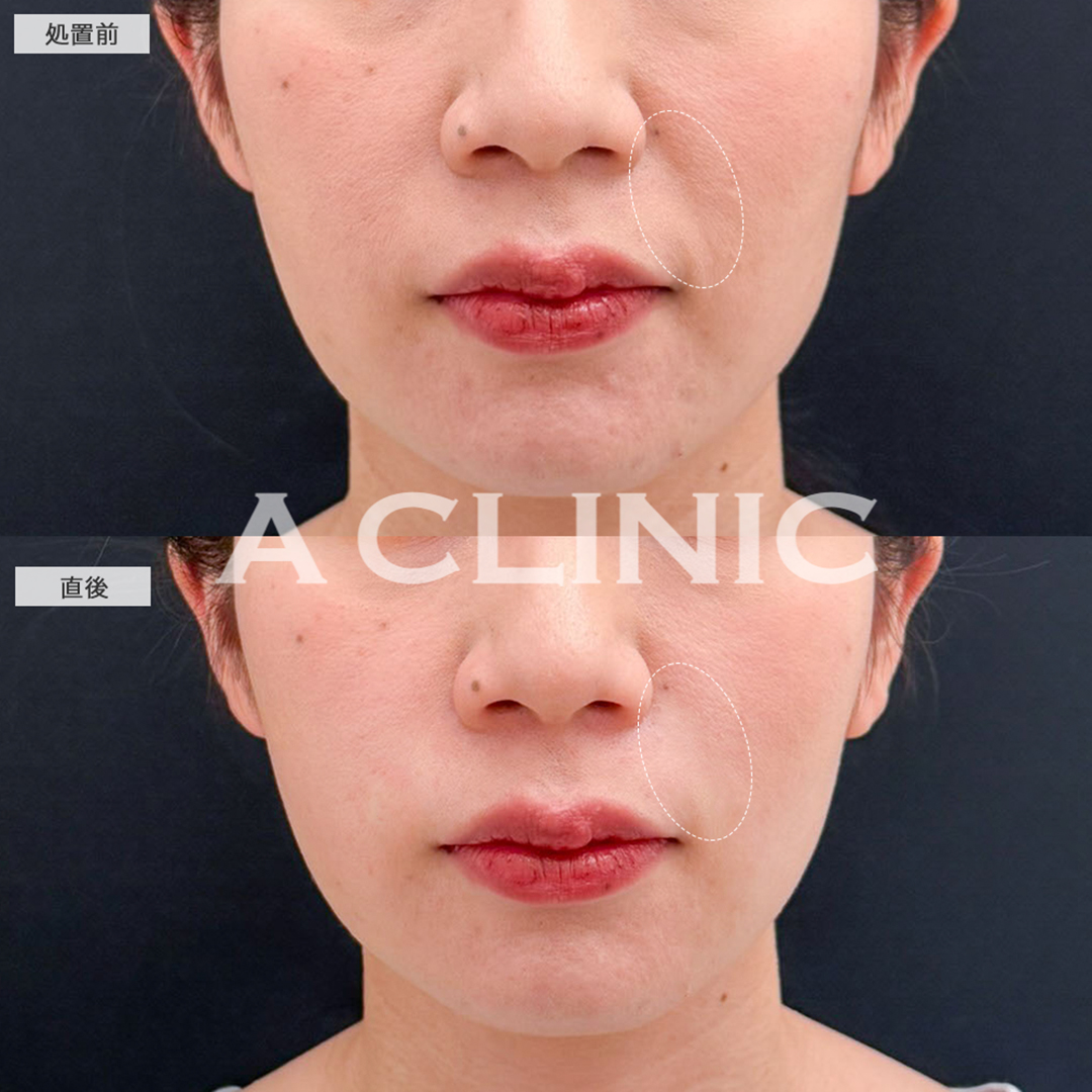 ヒアルロン酸注射(シワ)でほうれい線が目立たなくなり自信が持てました！こちら処置前と直後の症例です(30代女性)