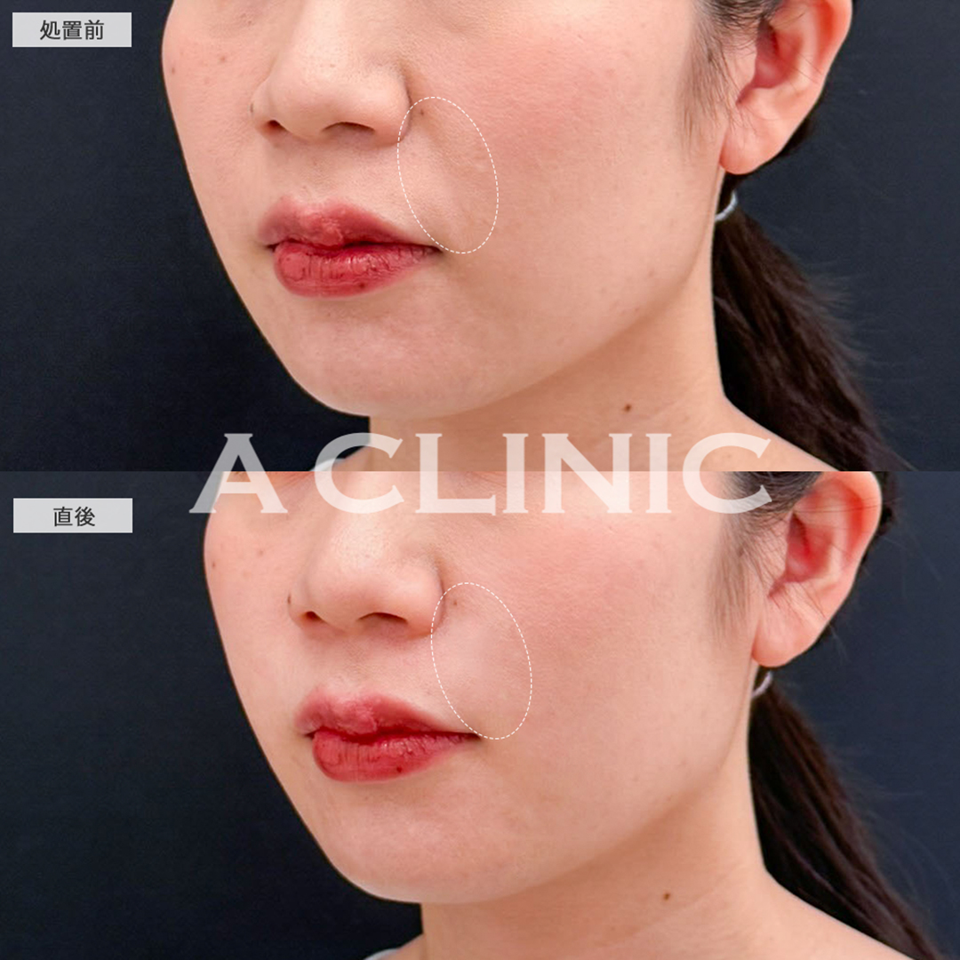 ヒアルロン酸注射(シワ)でほうれい線が目立たなくなり自信が持てました！こちら処置前と直後の症例です(30代女性)