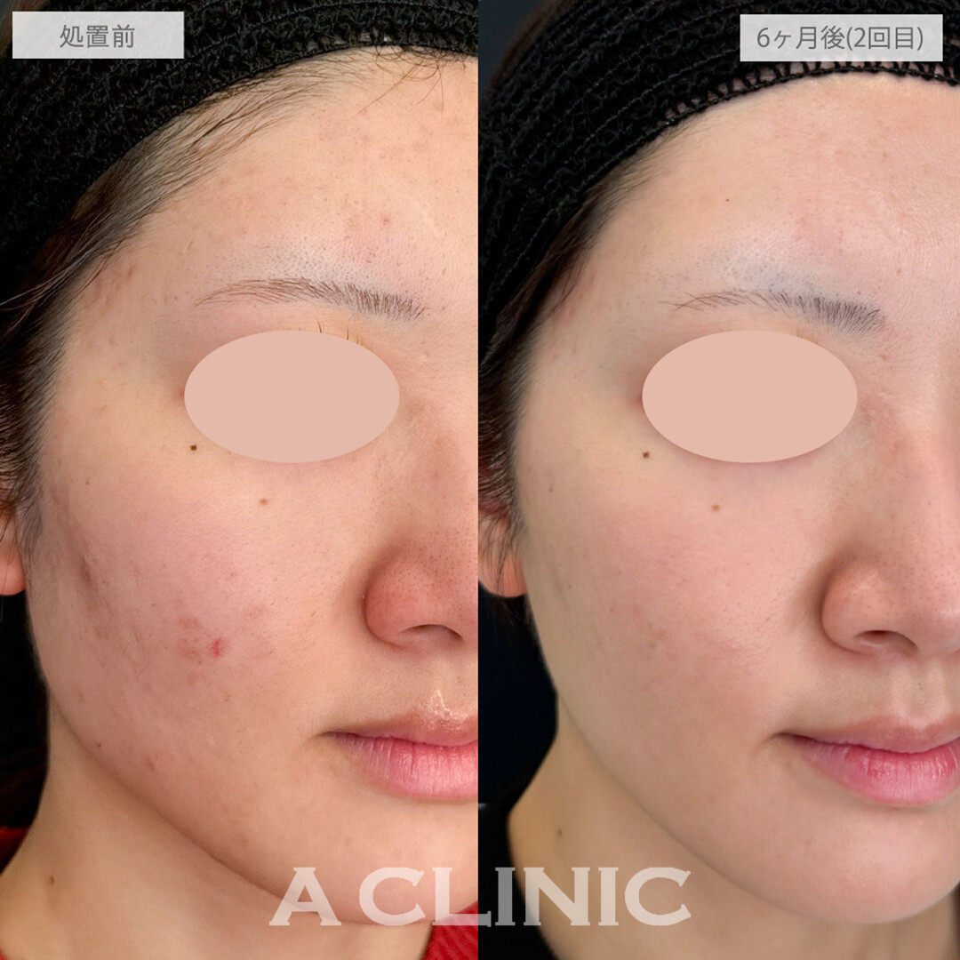 イソトレチノインとポテンツァとケミカルピーリングとクールビタミントリートメントで毛穴撲滅！処置前と6ヶ月後の症例です(20代女性)