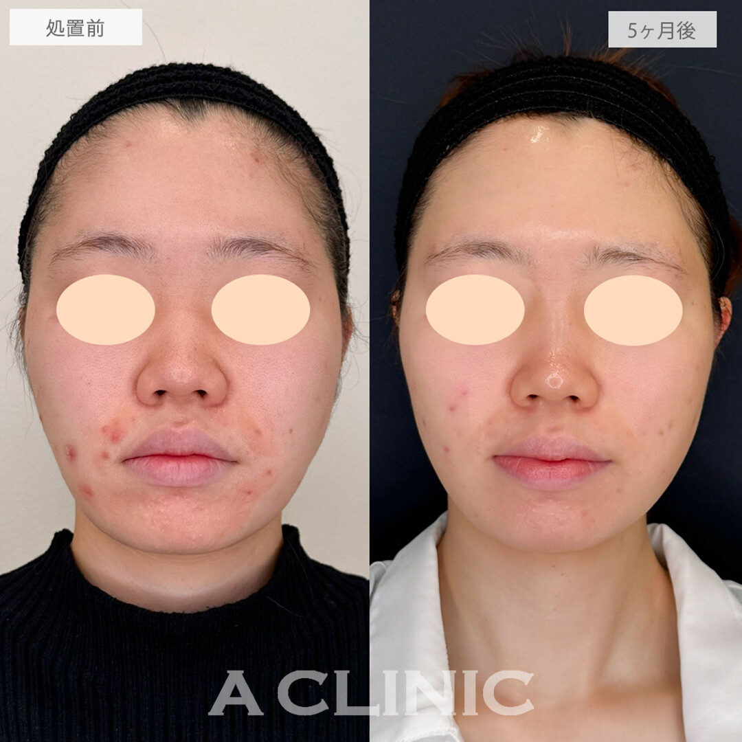 イソトレチノインで赤ニキビがかなり減りました！こちら処置前と5ヶ月後の症例です(20代女性)