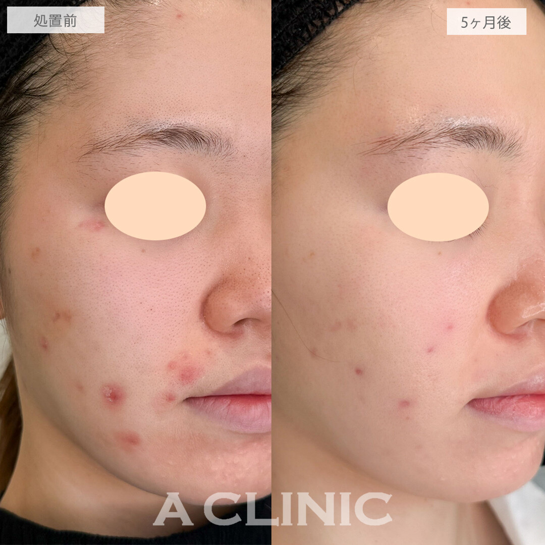イソトレチノインで赤ニキビがかなり減りました！こちら処置前と5ヶ月後の症例です(20代女性)