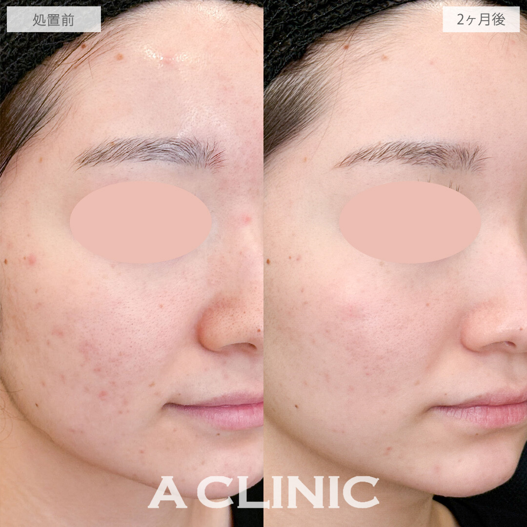 イソトレチノインで皮脂量が減ってニキビも毛穴も改善しました！こちら処置前と2か月後の症例です(20代女性)