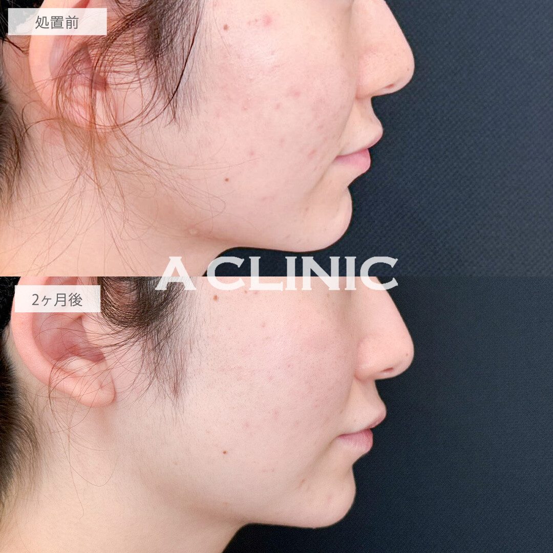 イソトレチノインで皮脂量が減ってニキビも毛穴も改善しました！こちら処置前と2か月後の症例です(20代女性)