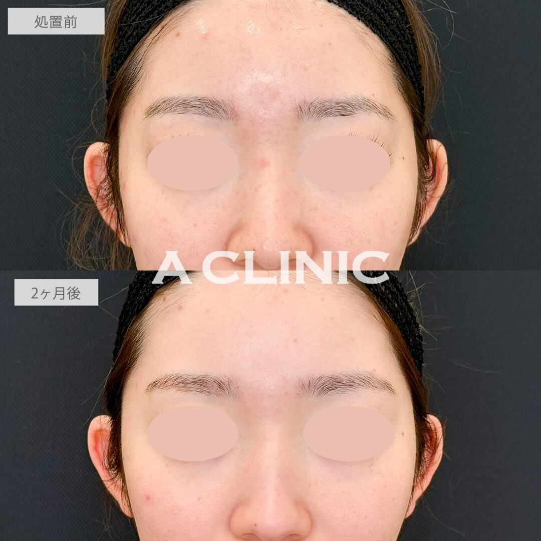 イソトレチノインで皮脂量が減ってニキビも毛穴も改善しました！こちら処置前と2か月後の症例です(20代女性)