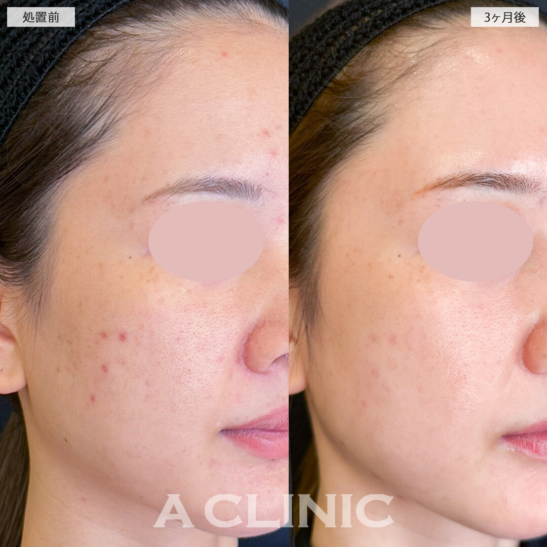 イソトレチノインでずっと気になっていた額のニキビも綺麗に改善されました！こちら処置前と3ヶ月後の症例です(20代女性)