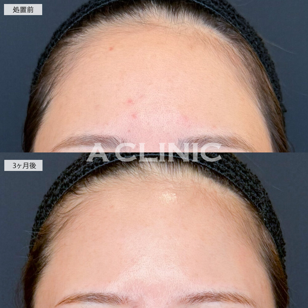 イソトレチノインでずっと気になっていた額のニキビも綺麗に改善されました！こちら処置前と3ヶ月後の症例です(20代女性)