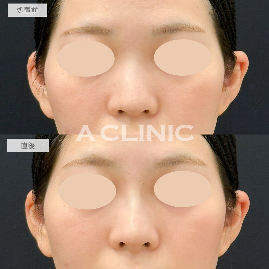 ジャスミンノーズでノーズシャドウいらずの鼻筋を形成！処置前と直後の症例です(20代女性)