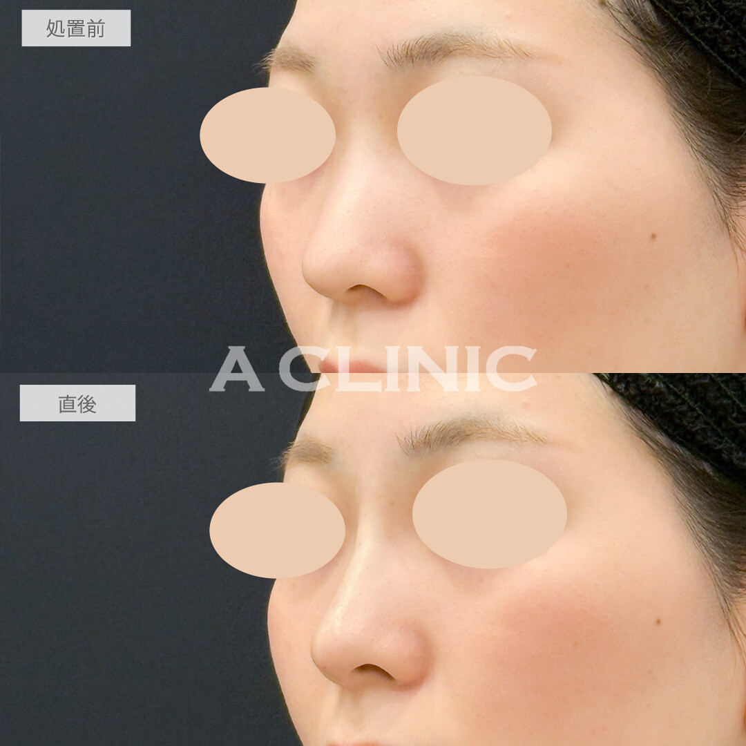 ジャスミンノーズでノーズシャドウいらずの鼻筋を形成！処置前と直後の症例です(20代女性)