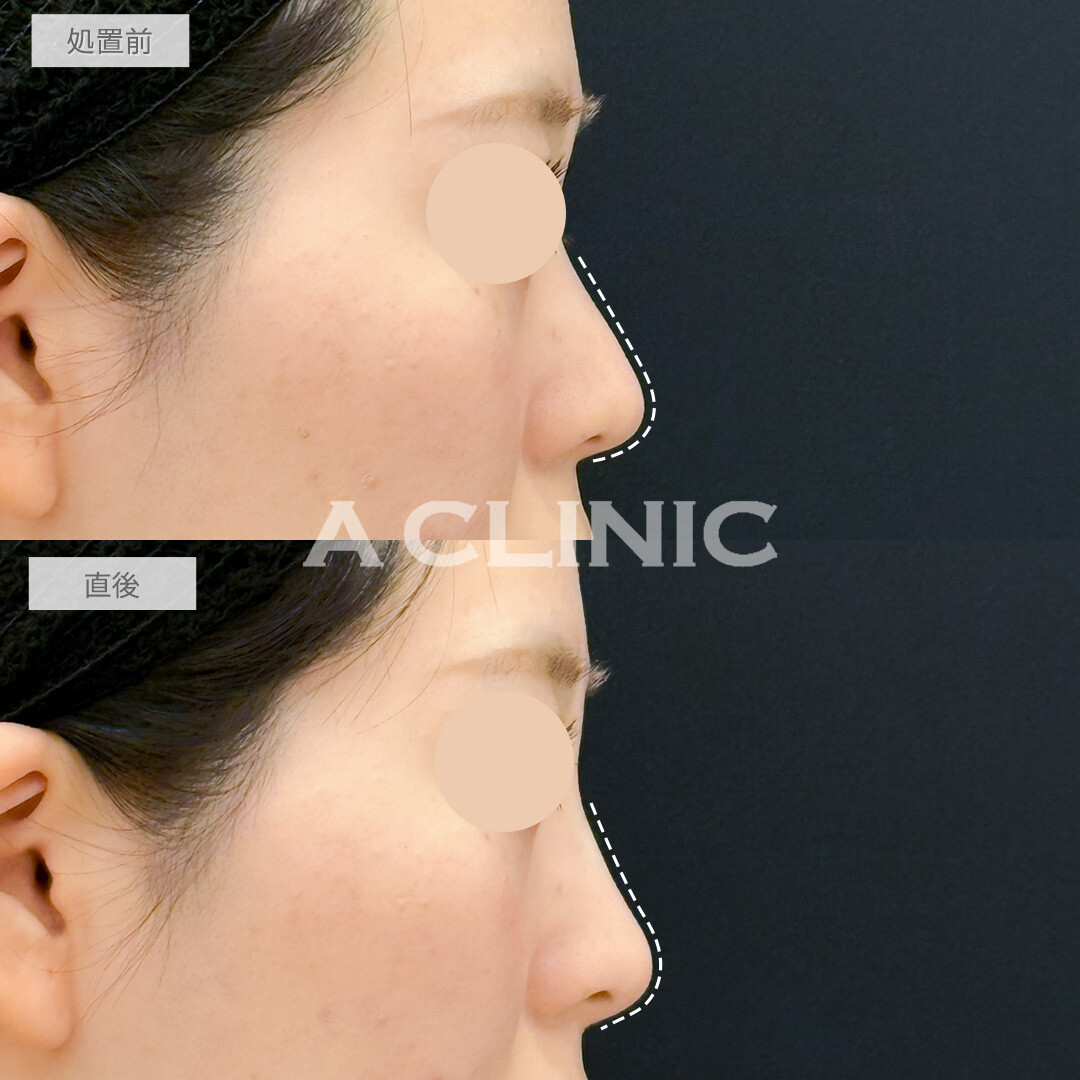ジャスミンノーズでノーズシャドウいらずの鼻筋を形成！処置前と直後の症例です(20代女性)