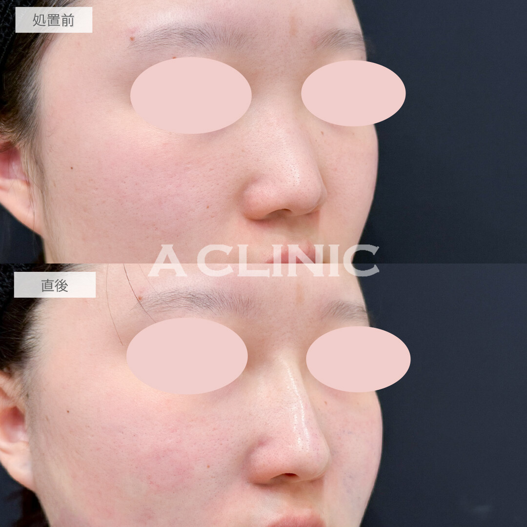 ジャスミンノーズは手軽にお顔のクオリティを上げてくれるプチ整形にオススメ！処置前と直後の症例です(20代女性)