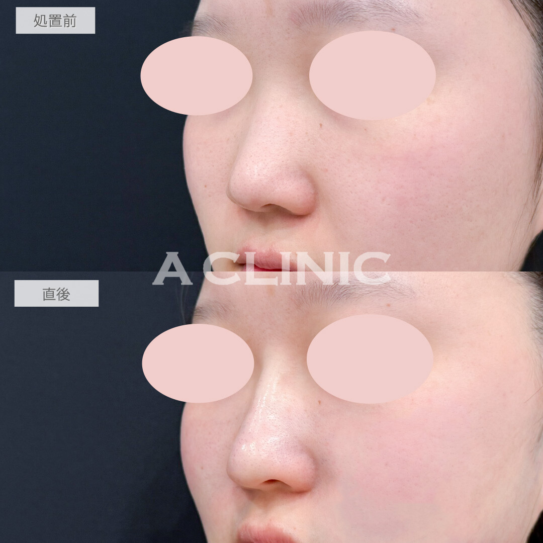 ジャスミンノーズは手軽にお顔のクオリティを上げてくれるプチ整形にオススメ！処置前と直後の症例です(20代女性)