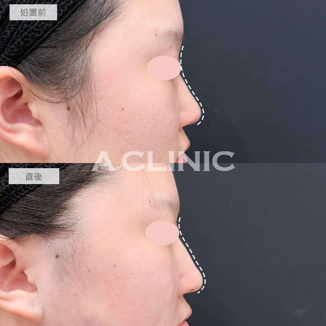 ジャスミンノーズは手軽にお顔のクオリティを上げてくれるプチ整形にオススメ！処置前と直後の症例です(20代女性)
