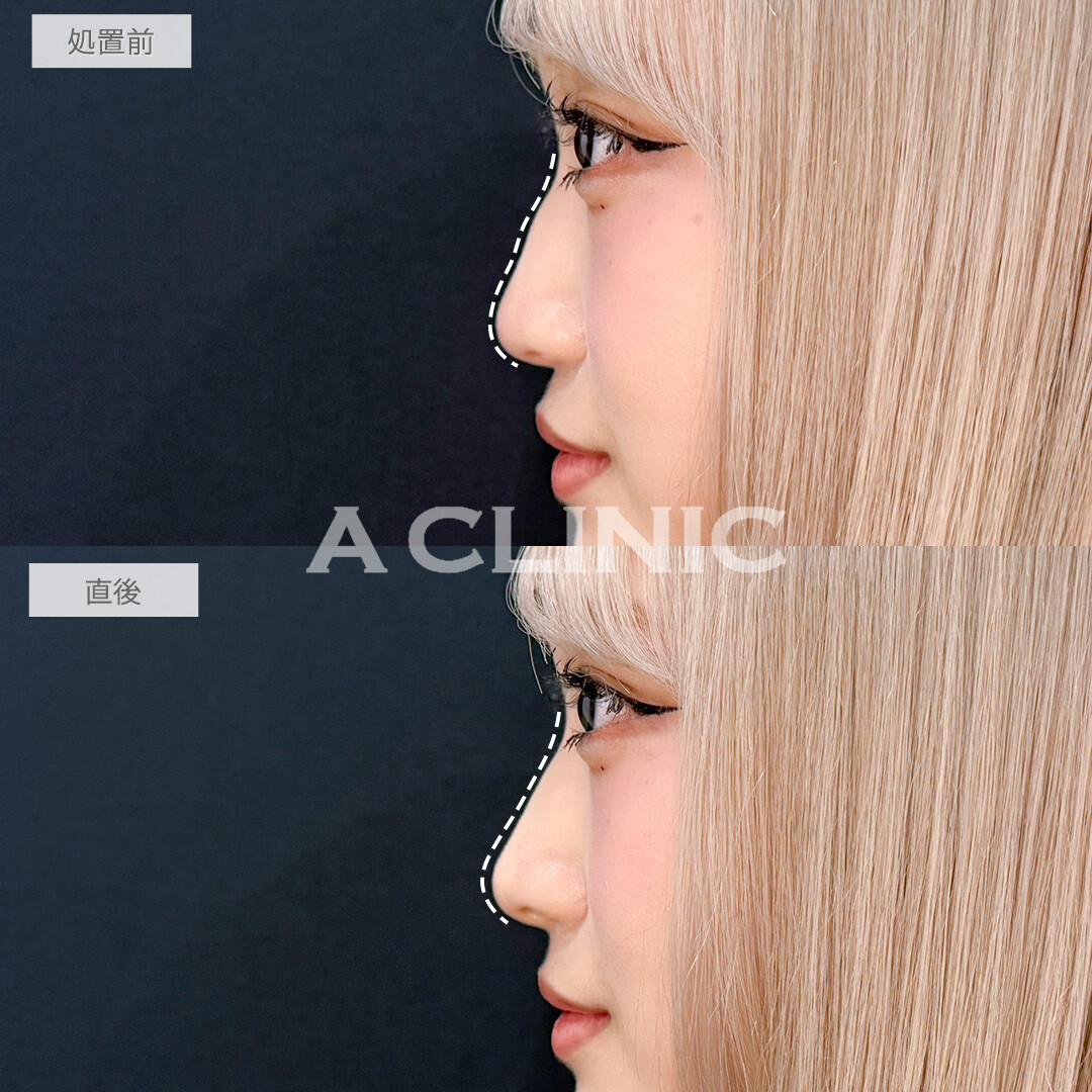 ジャスミンノーズで凹凸をなくして高く真っすぐな鼻筋になれました！処置前と直後の症例です(10代女性)