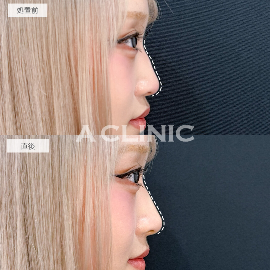 ジャスミンノーズで凹凸をなくして高く真っすぐな鼻筋になれました！処置前と直後の症例です(10代女性)