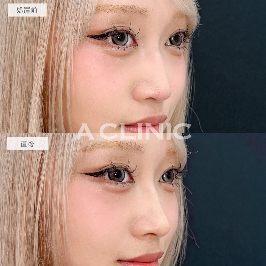 ジャスミンノーズで凹凸をなくして高く真っすぐな鼻筋になれました！処置前と直後の症例です(10代女性)